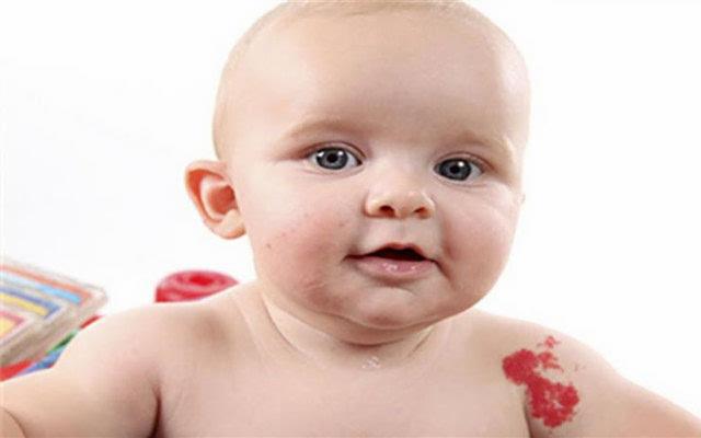婴儿无色素痣图片和无色素痣的区别（婴儿无色素痣图片论坛）